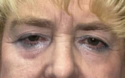 Eyelid Lift (Blepharoplasty/Ptosis Repair)