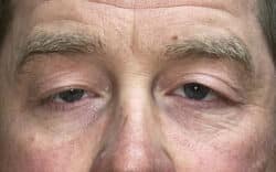 Eyelid Lift (Blepharoplasty/Ptosis Repair)