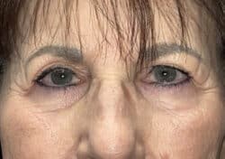 Brow/Forehead Lift