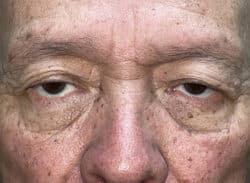 Combination Surgeries (eyelid lift and other)