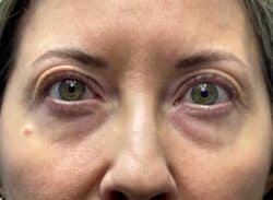 Combination Surgeries (eyelid lift and other)