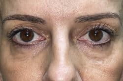 Upper Lid Blepharoplasty (upper eyelid lift)