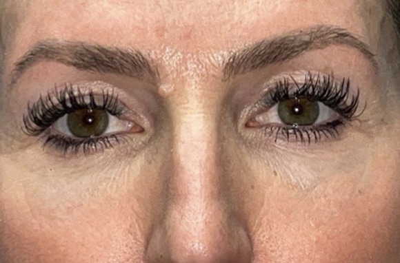Upper Lid Blepharoplasty (upper eyelid lift)