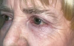 Eyelid Lift (Blepharoplasty/Ptosis Repair)