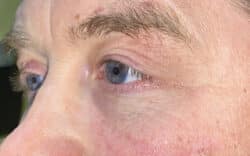 Eyelid Lift (Blepharoplasty/Ptosis Repair)