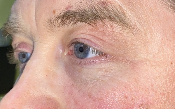 Eyelid Lift (Blepharoplasty/Ptosis Repair)