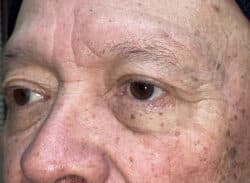 Combination Surgeries (eyelid lift and other)