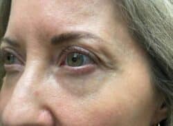 Combination Surgeries (eyelid lift and other)