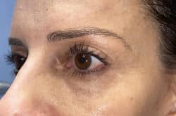 Upper Lid Blepharoplasty (upper eyelid lift)