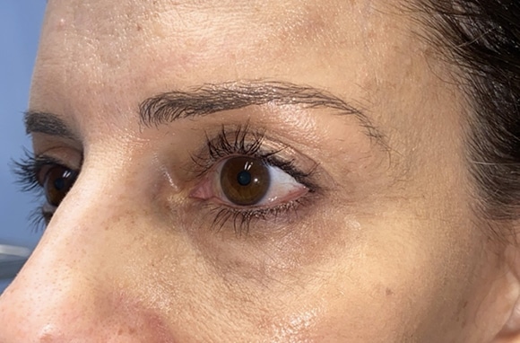 Upper Lid Blepharoplasty (upper eyelid lift)