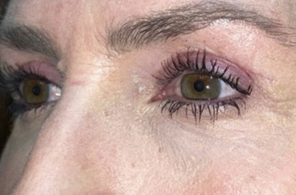 Upper Lid Blepharoplasty (upper eyelid lift)