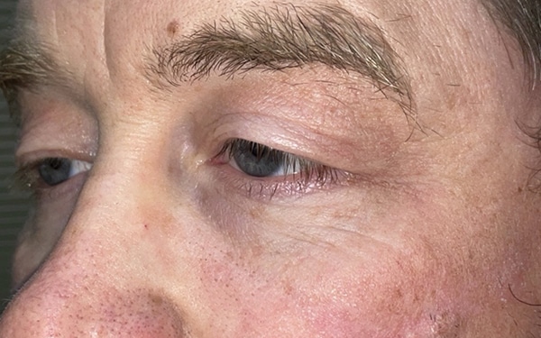 Eyelid Lift (Blepharoplasty/Ptosis Repair)