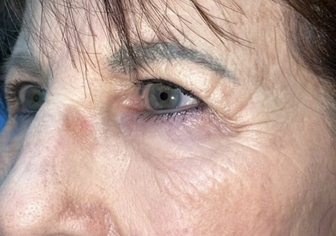 Brow/Forehead Lift