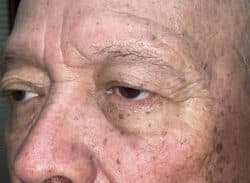 Combination Surgeries (eyelid lift and other)