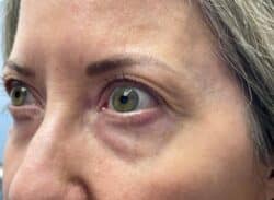 Combination Surgeries (eyelid lift and other)