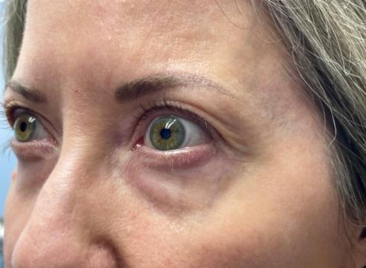 Combination Surgeries (eyelid lift and other)