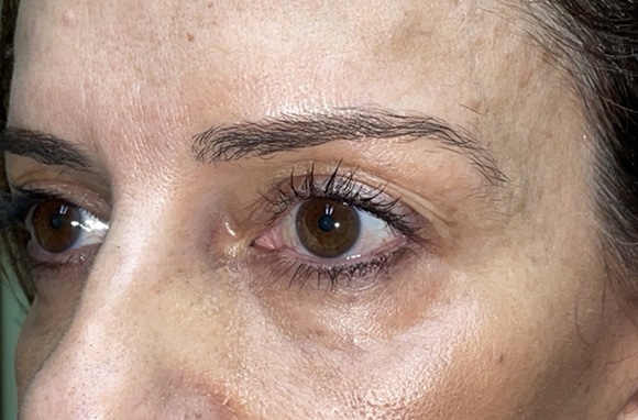 Upper Lid Blepharoplasty (upper eyelid lift)