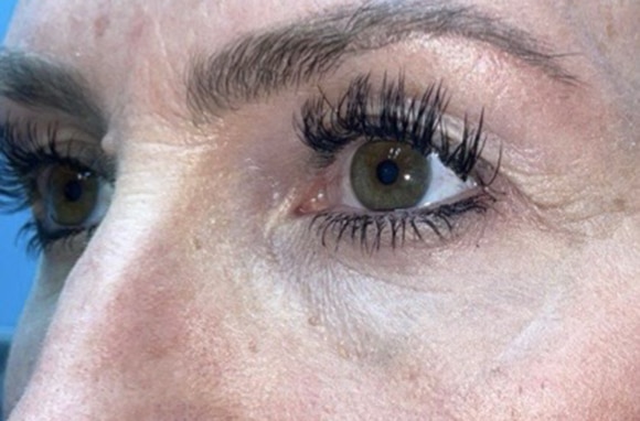Upper Lid Blepharoplasty (upper eyelid lift)