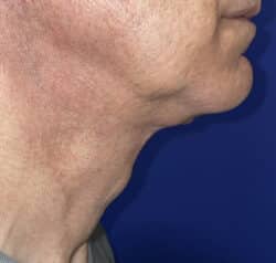 Face/Neck Lift