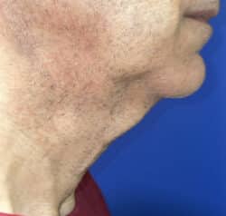 Face/Neck Lift