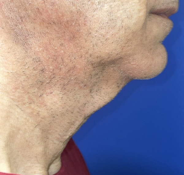 Face/Neck Lift