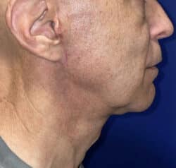 Face/Neck Lift
