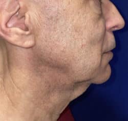 Face/Neck Lift