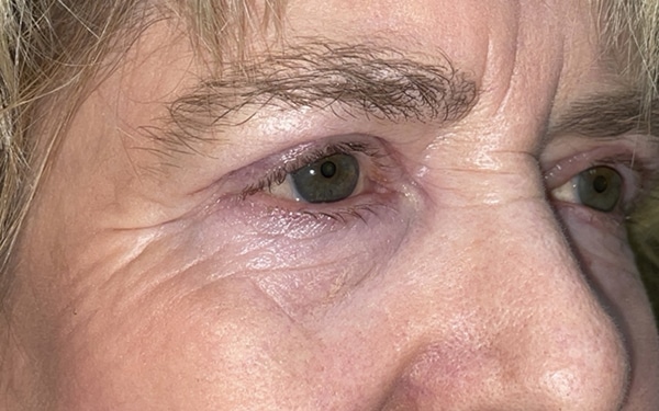 Eyelid Lift (Blepharoplasty/Ptosis Repair)