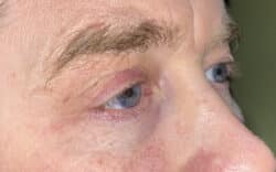 Eyelid Lift (Blepharoplasty/Ptosis Repair)