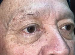 Combination Surgeries (eyelid lift and other)