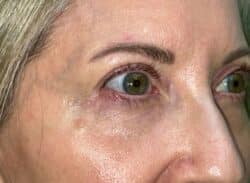 Combination Surgeries (eyelid lift and other)
