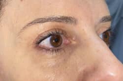 Upper Lid Blepharoplasty (upper eyelid lift)