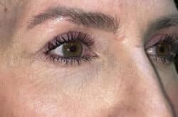 Upper Lid Blepharoplasty (upper eyelid lift)