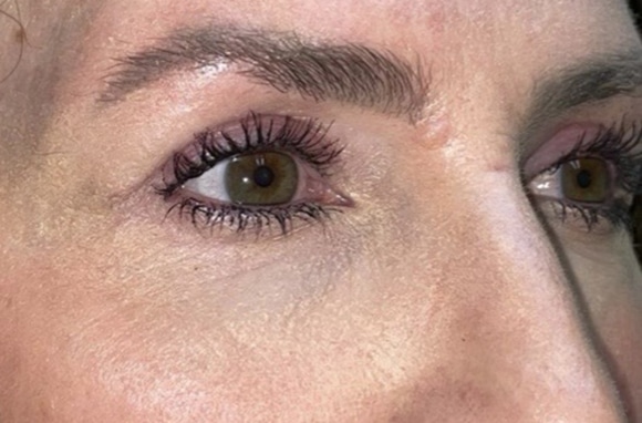 Upper Lid Blepharoplasty (upper eyelid lift)