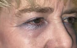 Eyelid Lift (Blepharoplasty/Ptosis Repair)