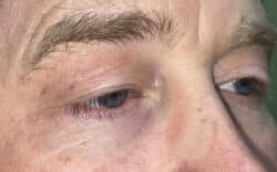 Eyelid Lift (Blepharoplasty/Ptosis Repair)