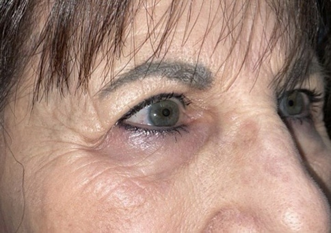 Brow/Forehead Lift