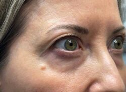 Combination Surgeries (eyelid lift and other)