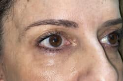 Upper Lid Blepharoplasty (upper eyelid lift)