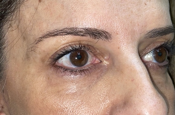Upper Lid Blepharoplasty (upper eyelid lift)