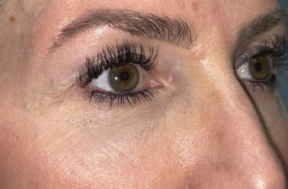 Upper Lid Blepharoplasty (upper eyelid lift)