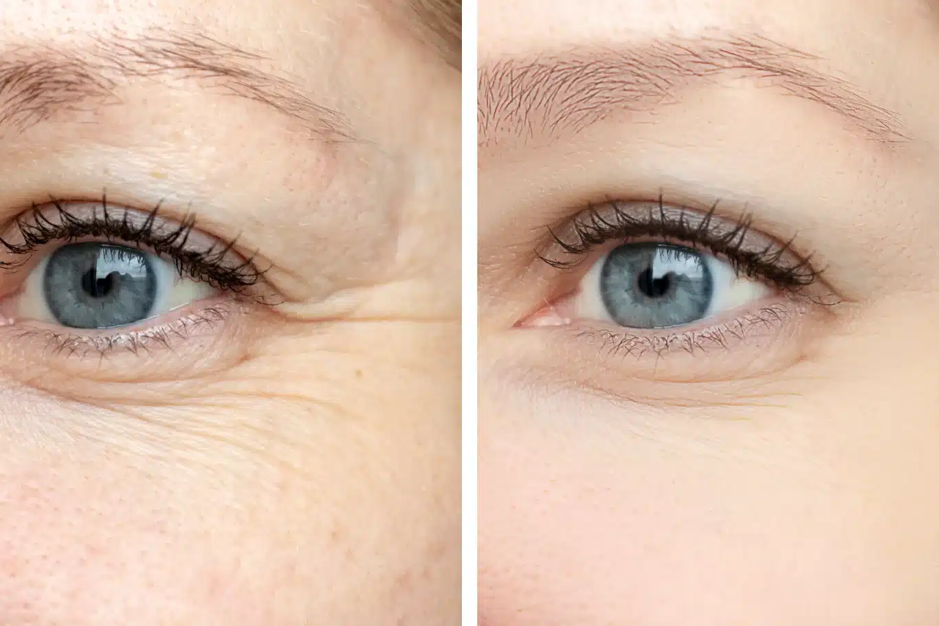 Before And After Comparison Of Botox Treatment close up side by side comparison of a persons eye