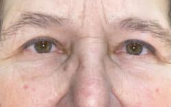 Eyelid Lift (Blepharoplasty/Ptosis Repair)