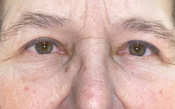Eyelid Lift (Blepharoplasty/Ptosis Repair)
