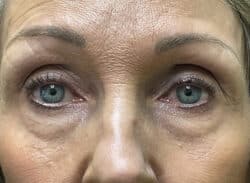 Combination Surgeries (eyelid lift and other)