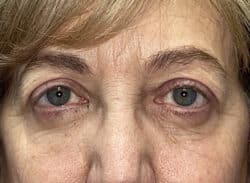 Combination Surgeries (eyelid lift and other)