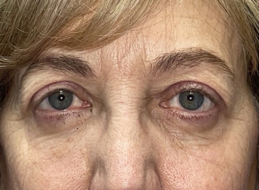 Combination Surgeries (eyelid lift and other)