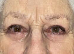 Combination Surgeries (eyelid lift and other)