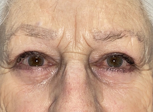 Combination Surgeries (eyelid lift and other)