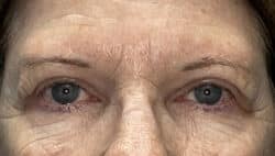 Combination Surgeries (eyelid lift and other)